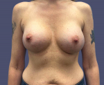 Breast Augmentation 24 After